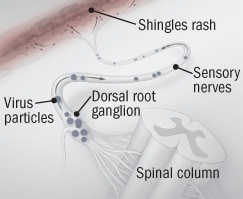 breaking out shingles