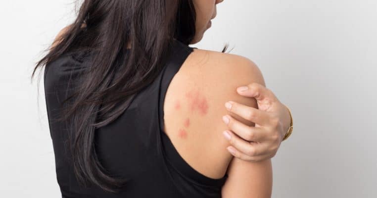initial rash shingles